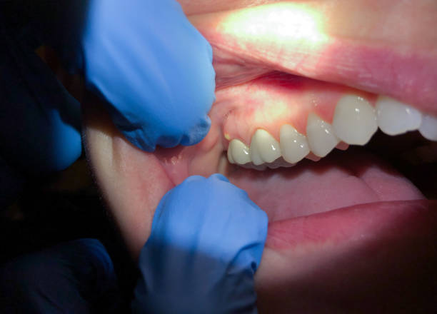 Best Emergency Dental Care for Abscessed Tooth in Shannon, GA
